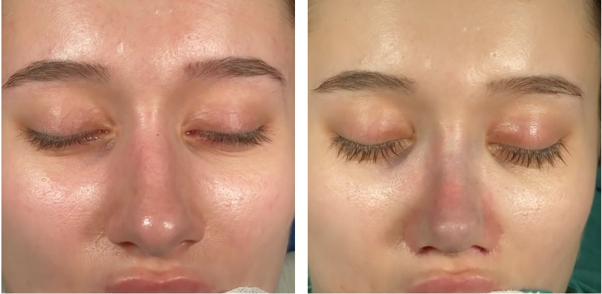 Before and after primary rhinoplasty in Istanbul