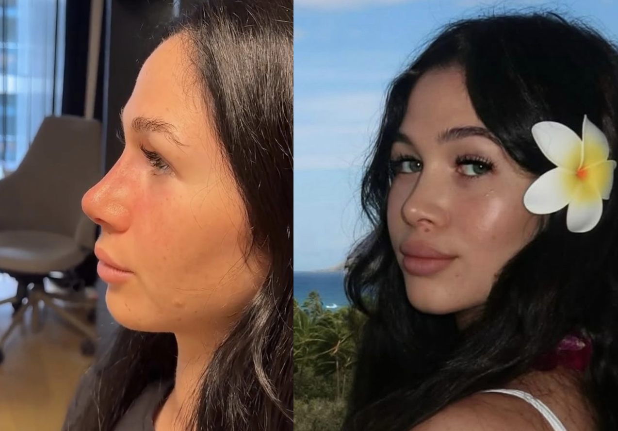 How Long Does Rhinoplasty Swelling Last?