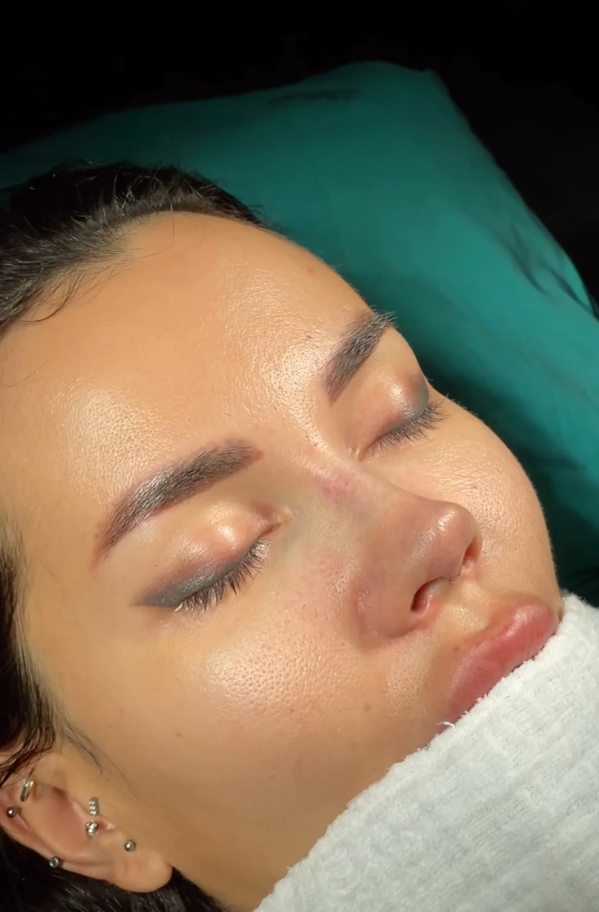 Open vs. Closed Rhinoplasty: What’s the Difference?