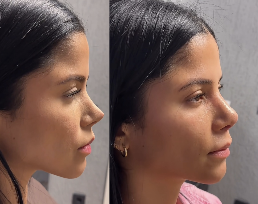 What Is Revision Rhinoplasty and When Is It Needed?