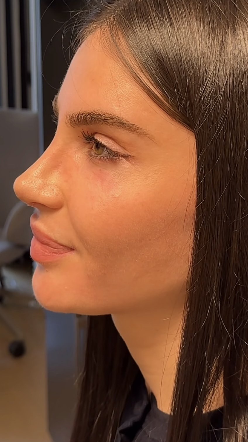 Can Rhinoplasty Improve Breathing?