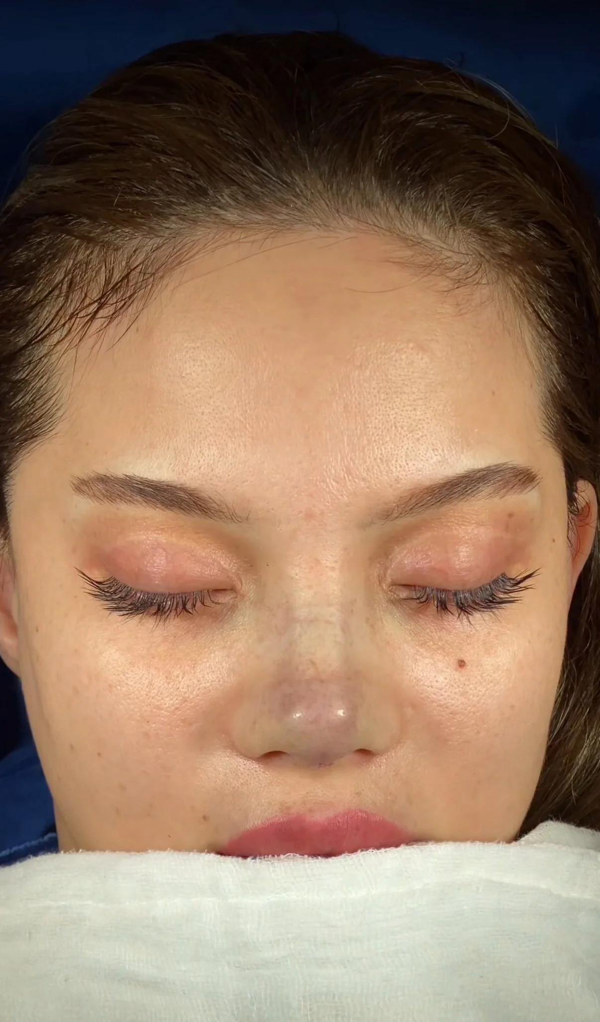 When Can I Return to Normal Life After Rhinoplasty?