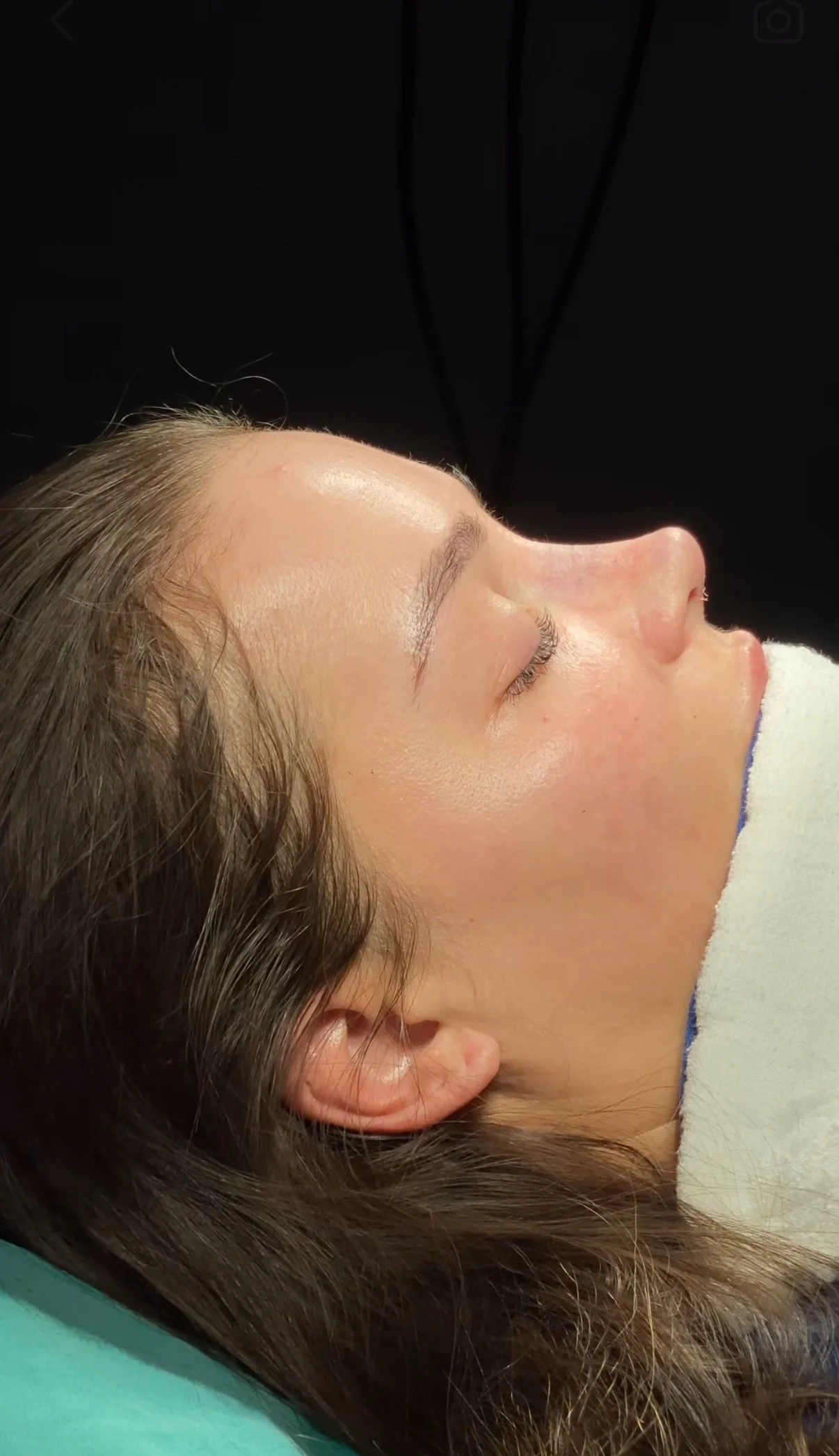 Can Rhinoplasty Fix a Crooked Nose?