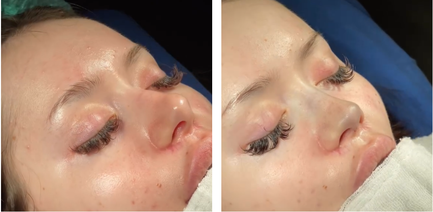 Before and after primary rhinoplasty revision rhinoplasty in Istanbul