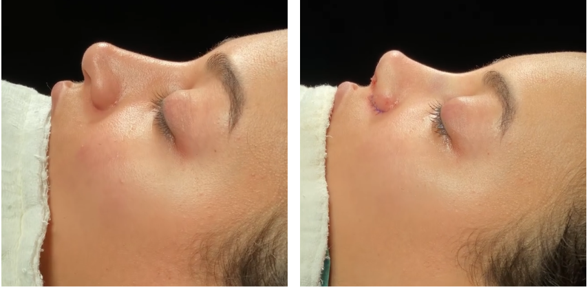 Before and after primary rhinoplasty revision rhinoplasty in Istanbul