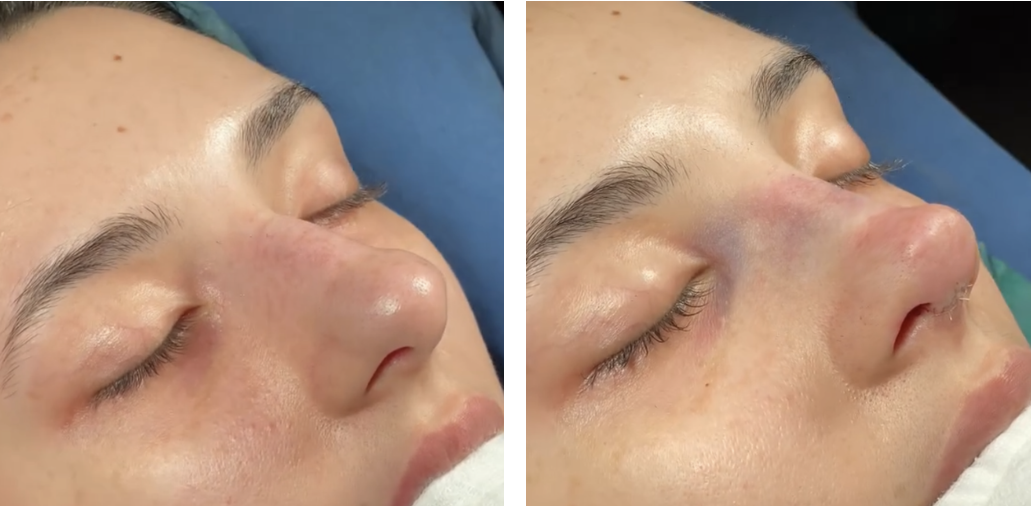 Before and after primary rhinoplasty revision rhinoplasty in Istanbul