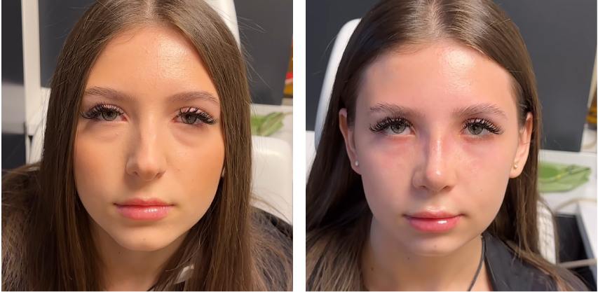 Before and after primary rhinoplasty revision rhinoplasty in Istanbul