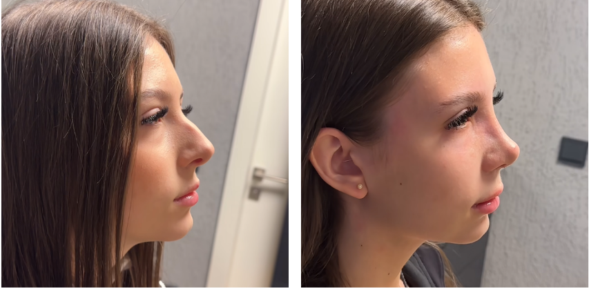 Before and after primary rhinoplasty revision rhinoplasty in Istanbul