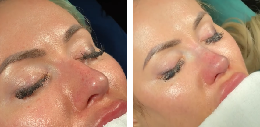 Before and after primary rhinoplasty revision rhinoplasty in Istanbul