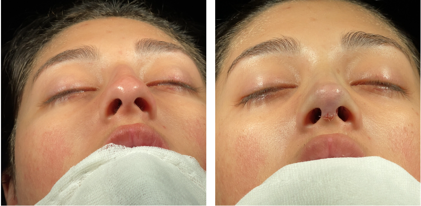 Before and after primary rhinoplasty revision rhinoplasty in Istanbul