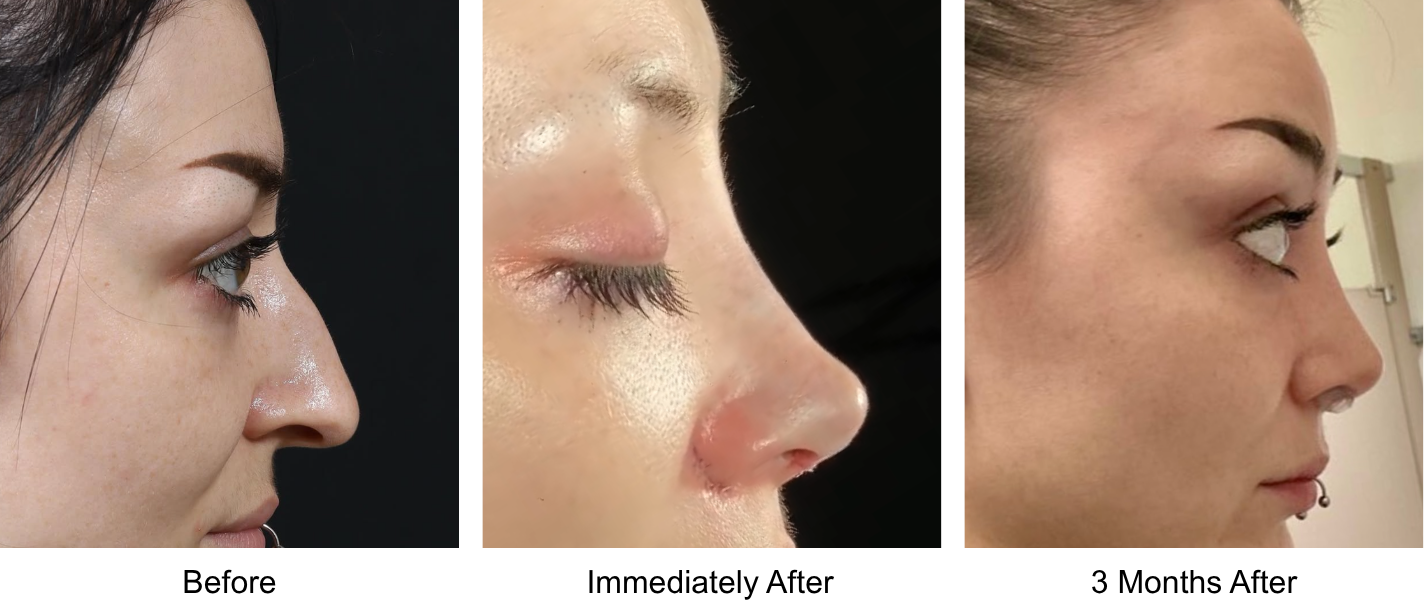 Before and after primary rhinoplasty revision rhinoplasty in Istanbul