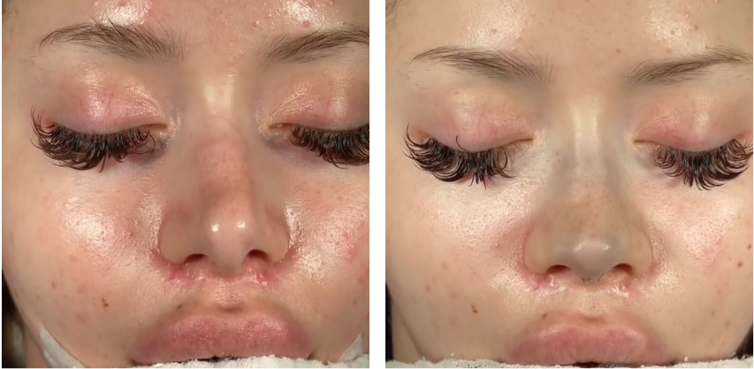 Before and after primary rhinoplasty in Istanbul