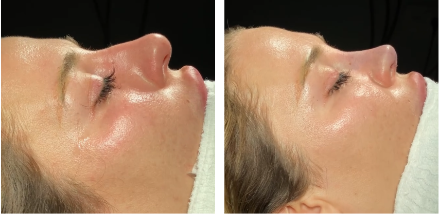 Before and after primary rhinoplasty revision rhinoplasty in Istanbul