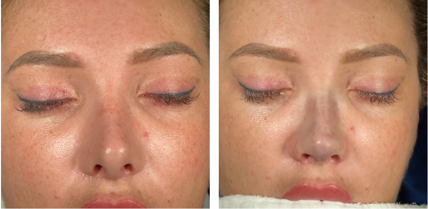 Before and after primary rhinoplasty revision rhinoplasty in Istanbul