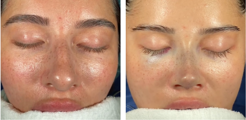 Before and after primary rhinoplasty in Istanbul