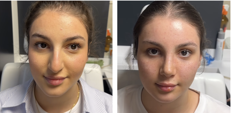 Before and after primary rhinoplasty revision rhinoplasty in Istanbul