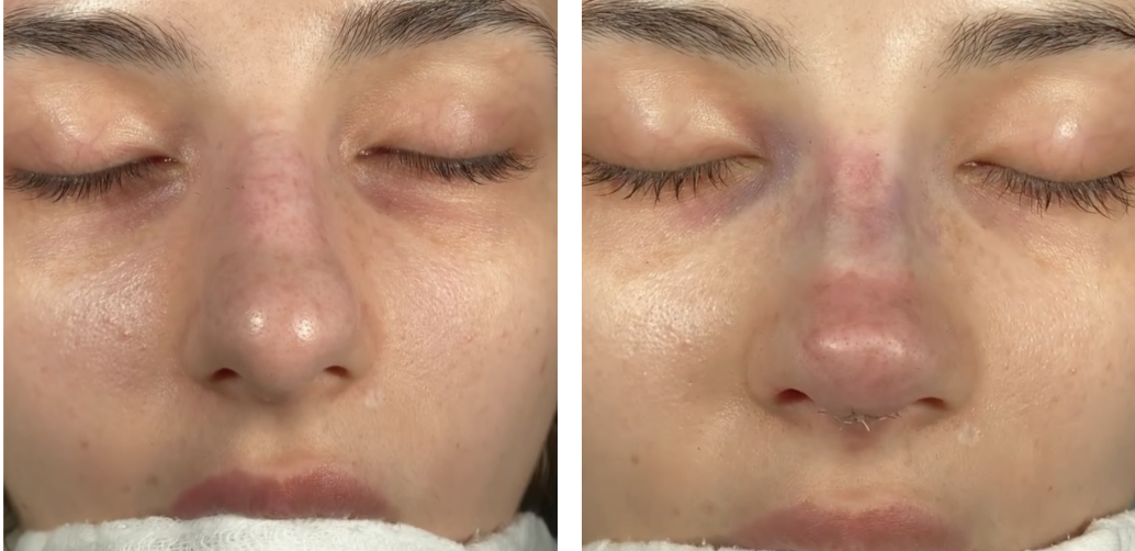 Before and after primary rhinoplasty revision rhinoplasty in Istanbul