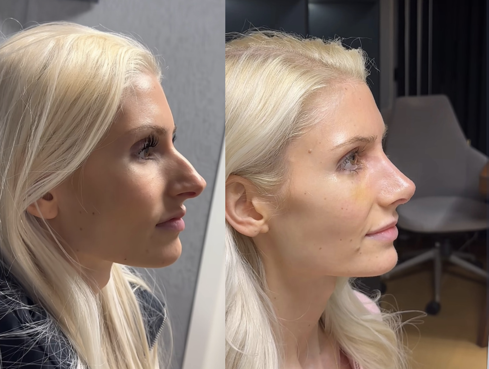International rhinoplasty journey in Istanbul