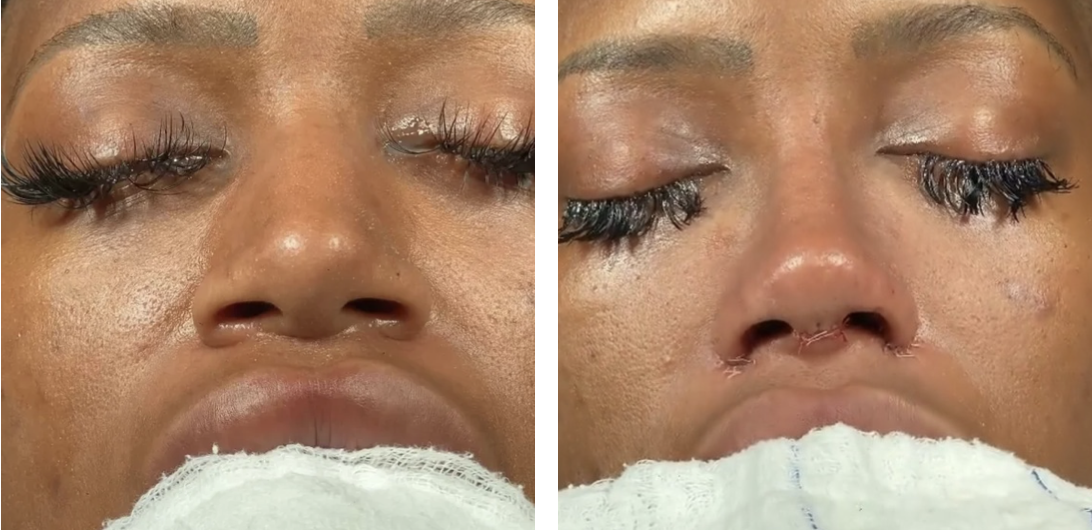 Before and after primary rhinoplasty in Istanbul