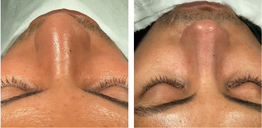 Before and after primary rhinoplasty revision rhinoplasty in Istanbul