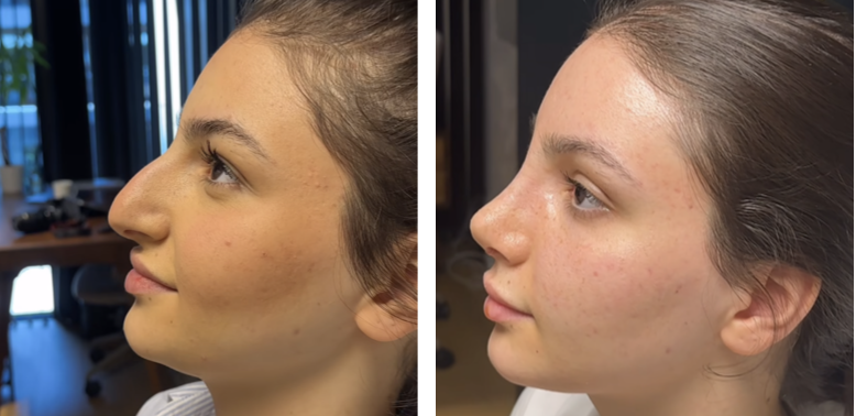 Before and after primary rhinoplasty revision rhinoplasty in Istanbul