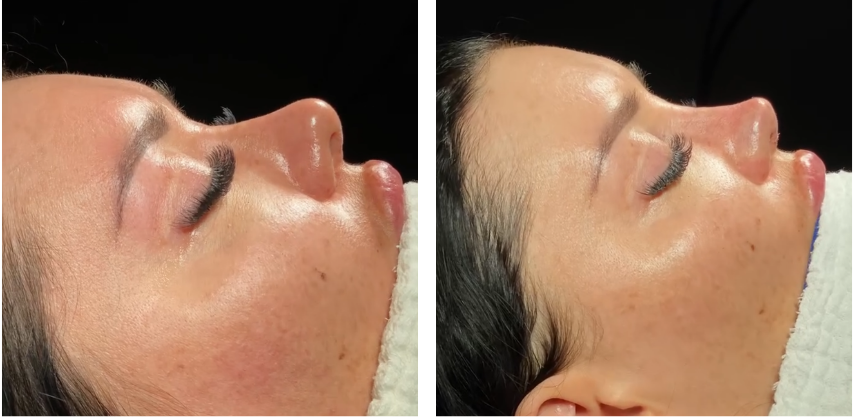 Before and after primary rhinoplasty revision rhinoplasty in Istanbul