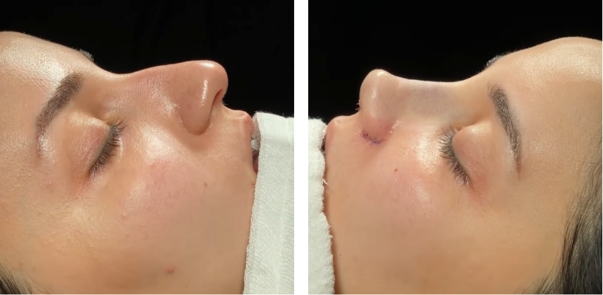 Before and after primary rhinoplasty revision rhinoplasty in Istanbul