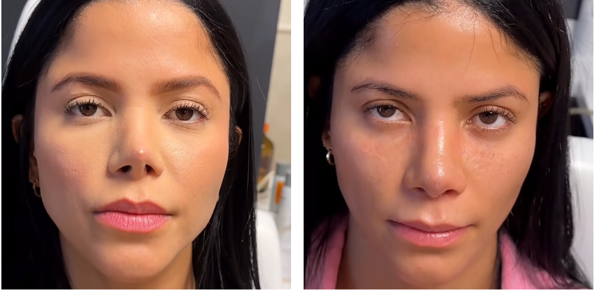 Before and after primary rhinoplasty revision rhinoplasty in Istanbul