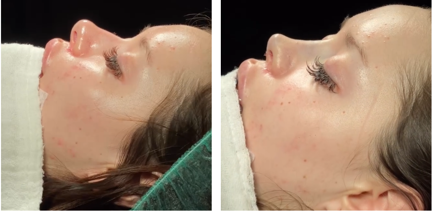 Before and after primary rhinoplasty revision rhinoplasty in Istanbul