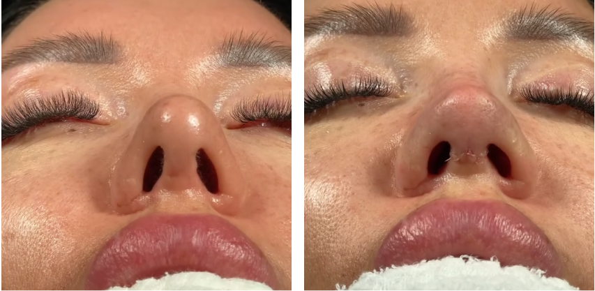 Before and after primary rhinoplasty revision rhinoplasty in Istanbul
