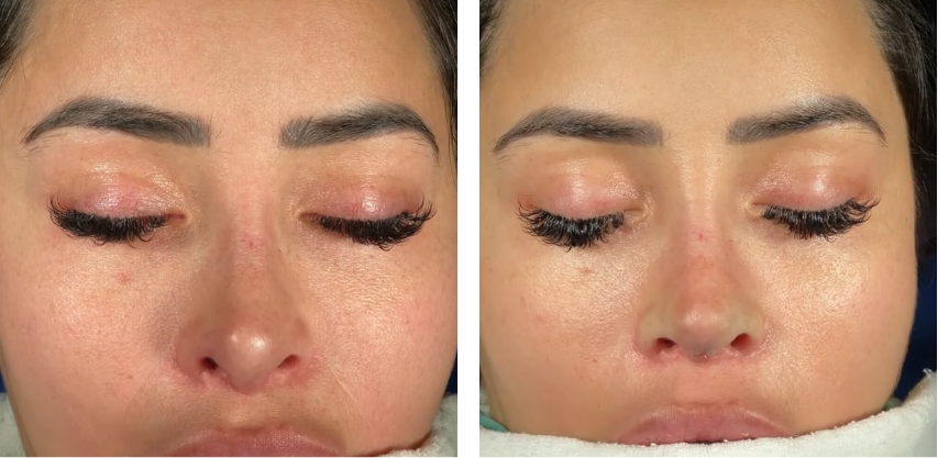 Close-up of a woman's face with eyes closed, showing before and after eyelash extension application.