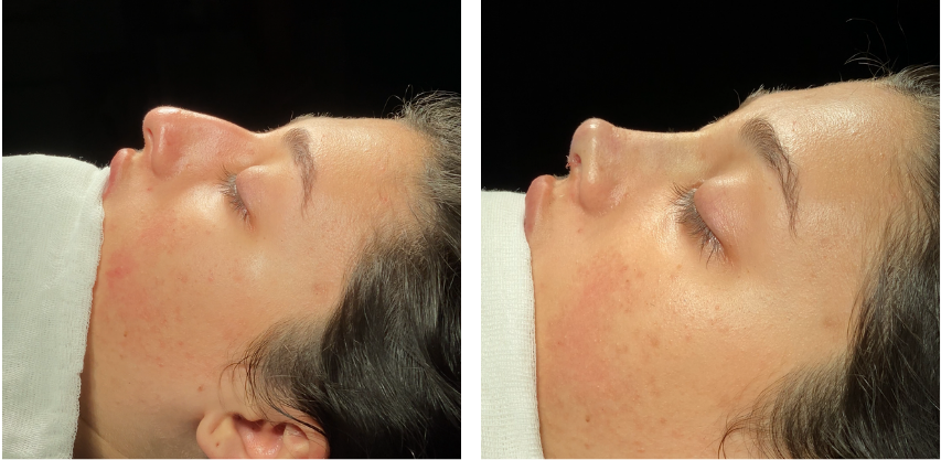 Before and after primary rhinoplasty revision rhinoplasty in Istanbul