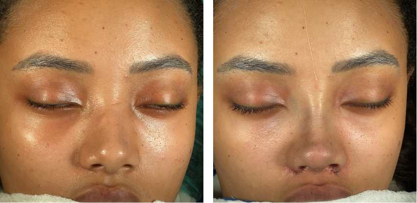 Before and after primary rhinoplasty revision rhinoplasty in Istanbul