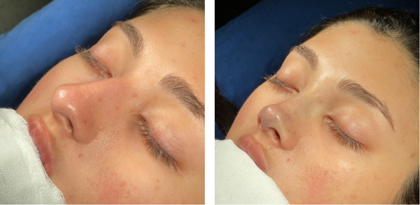 Before and after primary rhinoplasty revision rhinoplasty in Istanbul