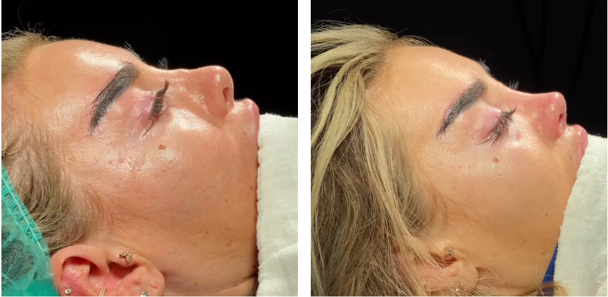 Before and after primary rhinoplasty revision rhinoplasty in Istanbul