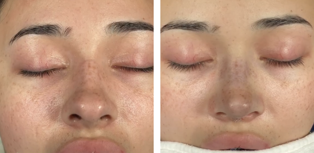 Before and after primary rhinoplasty in Istanbul
