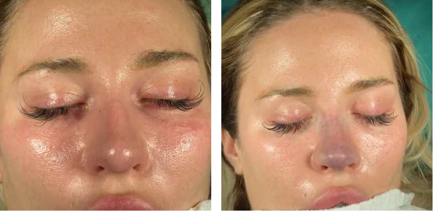 Before and after primary rhinoplasty revision rhinoplasty in Istanbul
