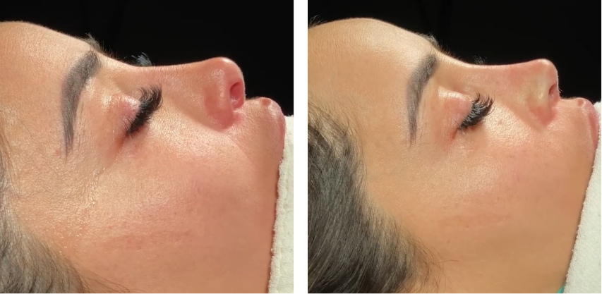 Before and after primary rhinoplasty revision rhinoplasty in Istanbul