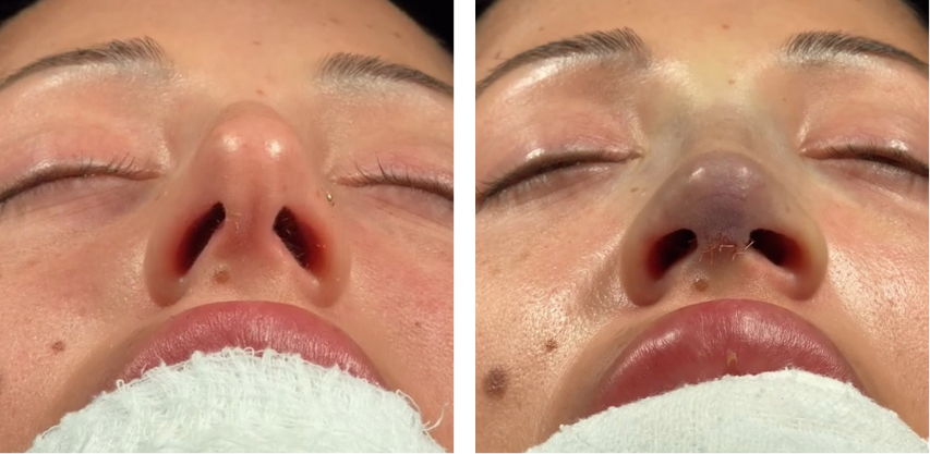 Before and after primary rhinoplasty revision rhinoplasty in Istanbul