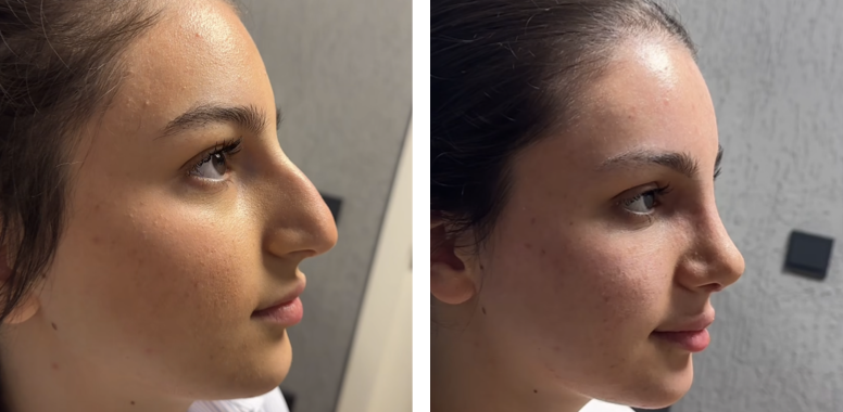 Before and after primary rhinoplasty revision rhinoplasty in Istanbul