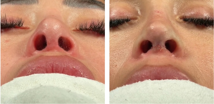 Before and after primary rhinoplasty revision rhinoplasty in Istanbul