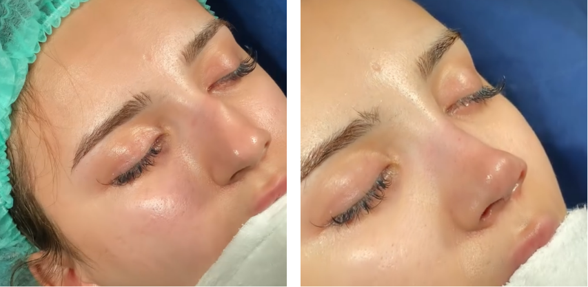 Before and after primary rhinoplasty revision rhinoplasty in Istanbul