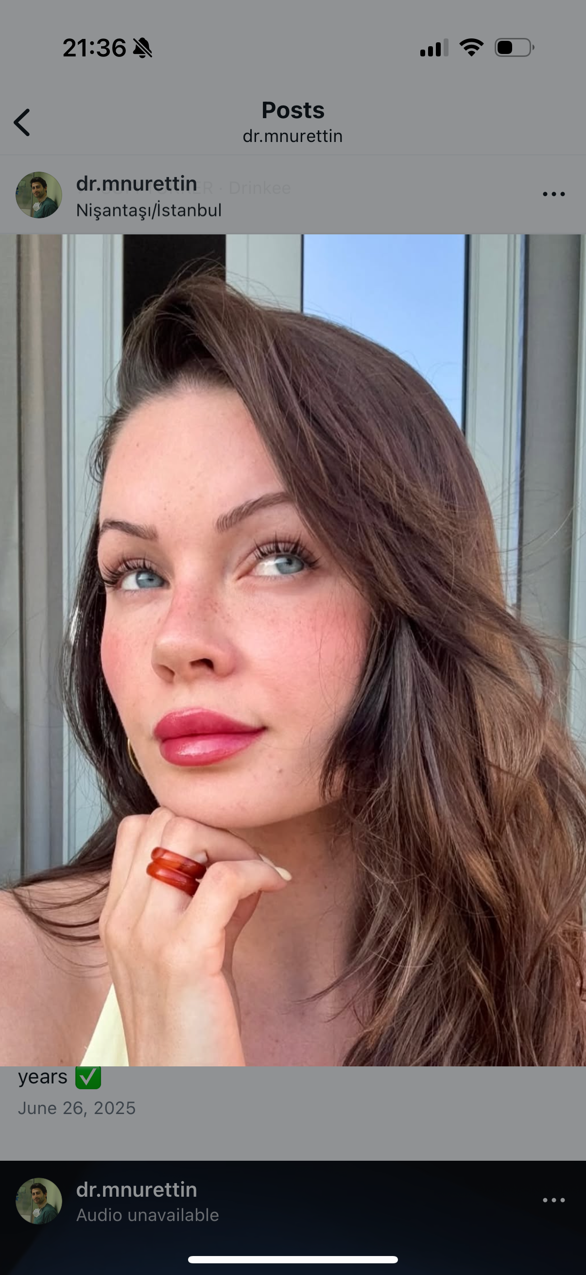 Primary rhinoplasty before and after results