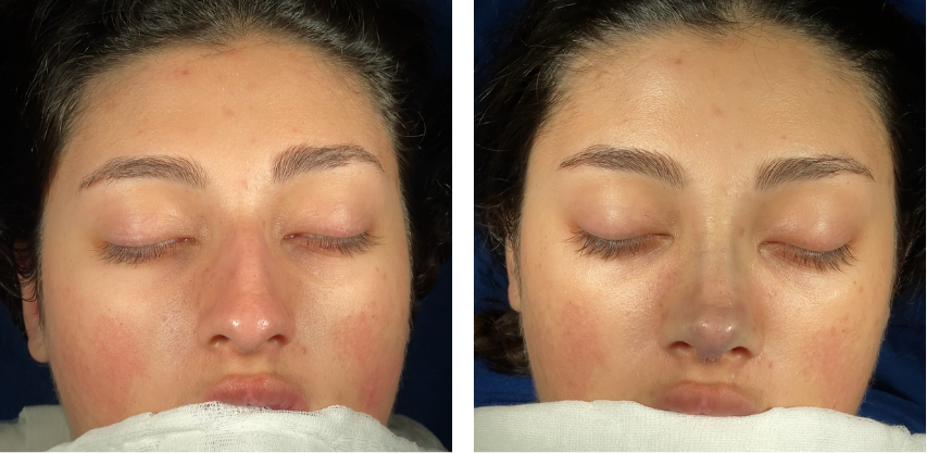 Before and after primary rhinoplasty revision rhinoplasty in Istanbul