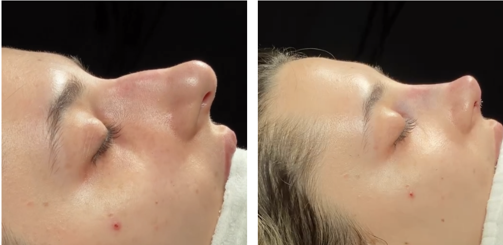 Before and after primary rhinoplasty revision rhinoplasty in Istanbul
