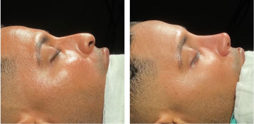 Before and after primary rhinoplasty revision rhinoplasty in Istanbul