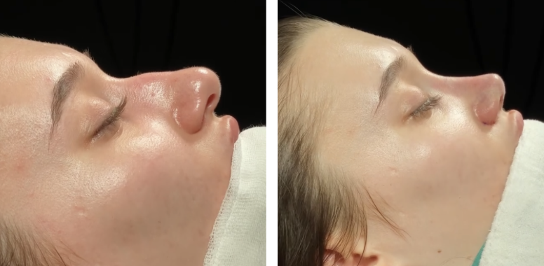 Before and after primary rhinoplasty in Istanbul