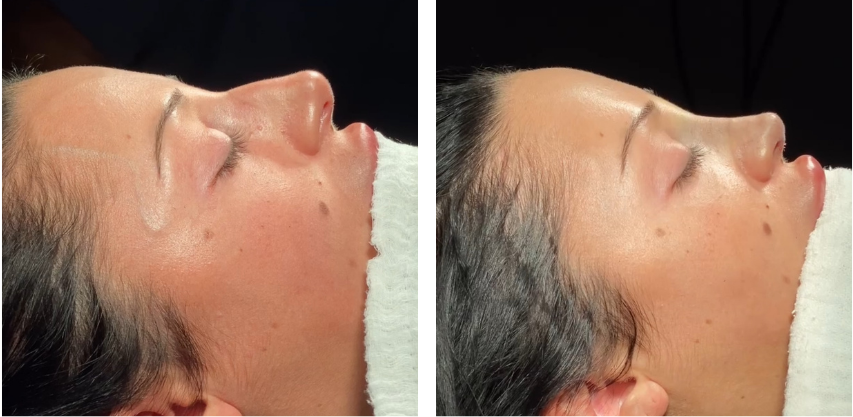 Before and after primary rhinoplasty revision rhinoplasty in Istanbul