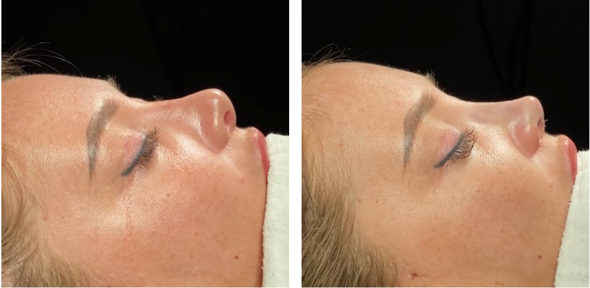Before and after primary rhinoplasty revision rhinoplasty in Istanbul