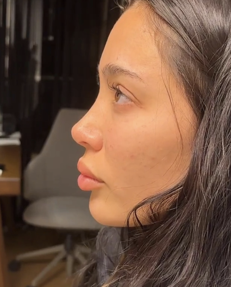 Rhinoplasty recovery after cast removal